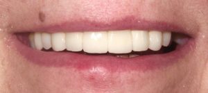 Photo of a patient after dental bridges treatment smiling with straight white teeth at Tonka Smiles