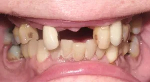 Photo of a patient with missing, crooked, & discolored teeth at Tonka Smiles Minnetonka