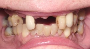 Photo of a patient with missing, crooked, & discolored teeth at Tonka Smiles Minnetonka