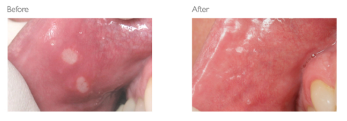 Before and after photos of a patient with cold sores getting treated with Laser Dentistry at Tonka Smiles Minnetonka