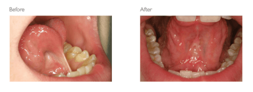 Before and after photos of patient easing tongue and check attachments using laser dentistry at Tonka Smiles