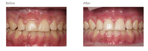 Before and after photo of a patient using laser dentistry reshaping a gummy smile at Tonka Smiles