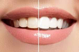 Photo of a woman's teeth before and after teeth whitening treatment at Tonka Smiles Minnetonka MN