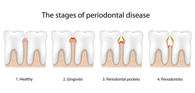 Illustration showing stages of periodontal disease