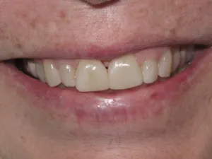 Photo of a patient after composite filling treatment at Tonka Smiles Minnetonka
