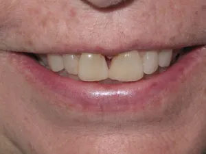 Photo of a patient before composite filling treatment at Tonka Smiles Minnetonka