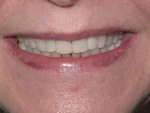 Photo of a patient smiling after Dental Crown Treatment at Tonka Smiles Minnetonka