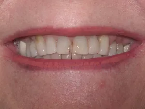 Photo of a patient Before Dental Crown Treatment at Tonka Smiles Minnetonka