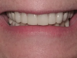 Photo of a patient smiling after Dental  Crown Treatment at Tonka Smiles Minnetonka 