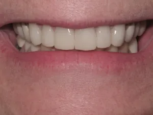 Photo of a patient smiling after Dental Crown Treatment at Tonka Smiles Minnetonka