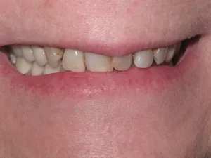 Photo of a patient Before Dental Crown Treatment at Tonka Smiles