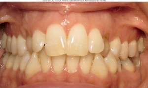 Photo of a patient's Teeth before getting Orthodontics, Teeth Whitening and Dental Implants Treatment at Tonka Smiles Minnetonka