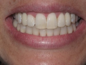 Photo of a patient's Teeth after getting Orthodontics, Teeth Whitening and Dental Implants Treatment at Tonka Smiles Minnetonka