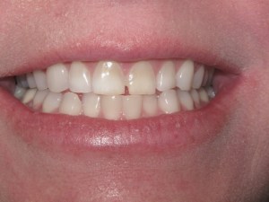 Photo of a patient before getting Porcelain Veneers treatment at Tonka Smiles Minnetonka MN