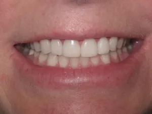Photo of a patient smiling after getting Porcelain Veneers at Tonka Smiles Minnetonka MN