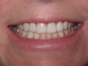 Photo of a patient smiling after getting Porcelain Veneers at Tonka Smiles Minnetonka MN
