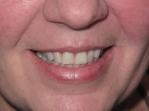 Photo of a patient before getting Porcelain Veneers treatment at Tonka Smiles Minnetonka MN