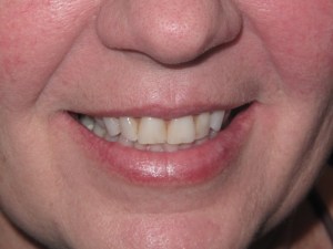 Photo of a patient before getting Porcelain Veneers treatment at Tonka Smiles Minnetonka MN