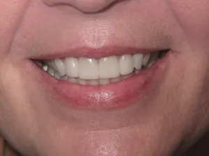 Photo of a patient smiling after getting Porcelain Veneers at Tonka Smiles Minnetonka MN