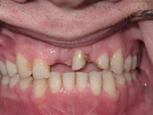 Photo of a patient before getting an Implant Bridge & Veneer