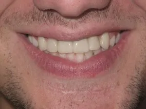 Photo of a patient after getting an Implant Bridge & Veneer