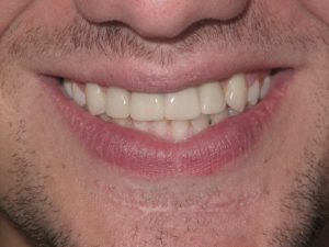 Photo of a patient after getting an Implant Bridge & Veneer