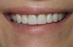 after smile makeover