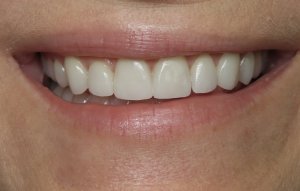 after smile makeover