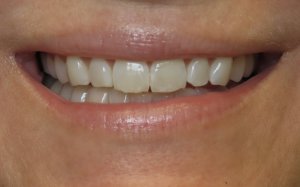 before smile makeover