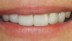 Jackie smile after treatment
