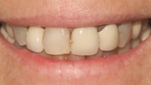 jackie smile before treatment