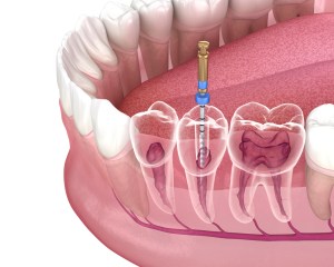 Endodontic,Root,Canal,Treatment,Process.,Medically,Accurate,Tooth,3d,Illustration.