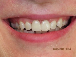 After dental crowns