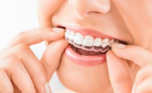 Woman putting in invisalign