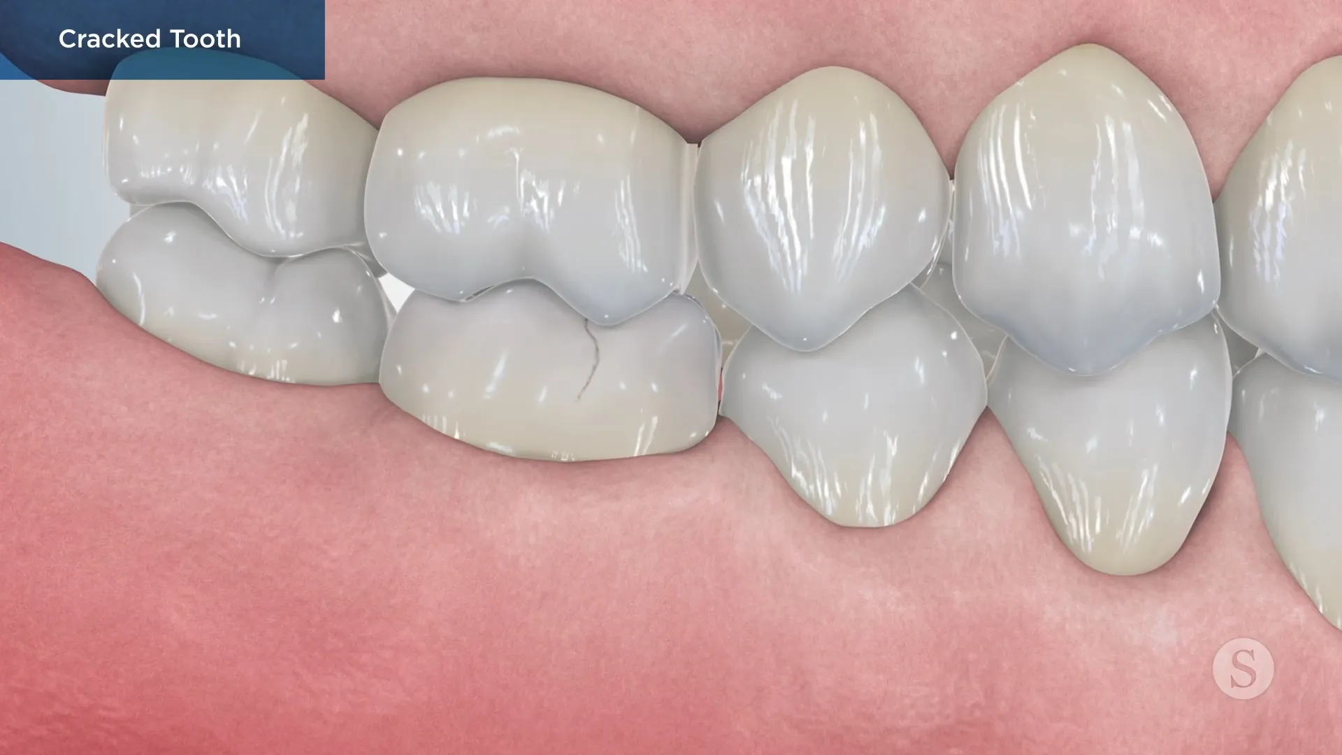 Cracked Tooth Video Thumbnail