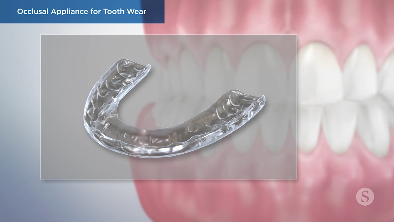 Occlusal Appliance for Tooth Wear Video Thumbnail