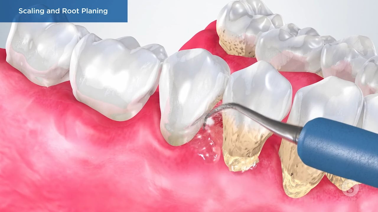 Scaling and Root Planing Video Thumbnail
