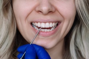 Woman smiling with white spot on teeth