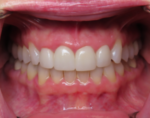 After Invisalign Anterior Crowns