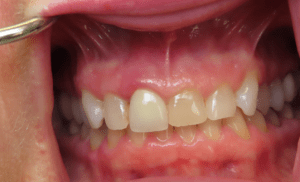 Before Invisalign Anterior Crowns